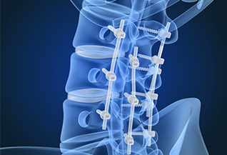 Neuro And Spine Surgeries